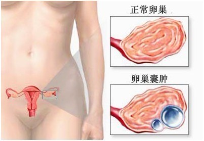 卵巢囊肿示意图