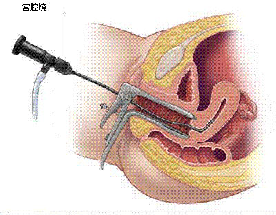 宫腹腔镜下子宫肌瘤剔除术