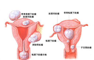 子宫肌瘤症状图